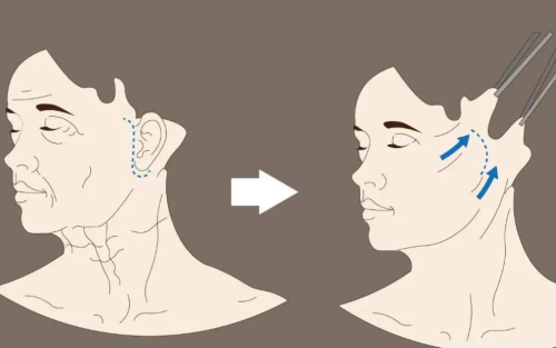谢洋春做拉皮手术多少钱？价格区间、影响费用的几个关键因素一次说明