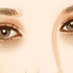 徐海艇双眼皮真的好吗？真实测评：确实不错，医生技术很稳，看实例