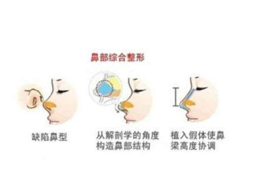 上海陈付国和钱玉鑫隆鼻哪个好？无假体妈生鼻vs直鼻微翘精致派！含价格