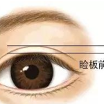 武汉王海平修复双眼皮怎么样？高难度修复强，术后反馈好