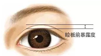 武汉王海平修复双眼皮怎么样？高难度修复强，术后反馈好