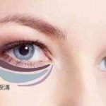 杨世界医生做眼袋手术怎么样？个性化定制、疤痕隐藏、注重眼周年轻化