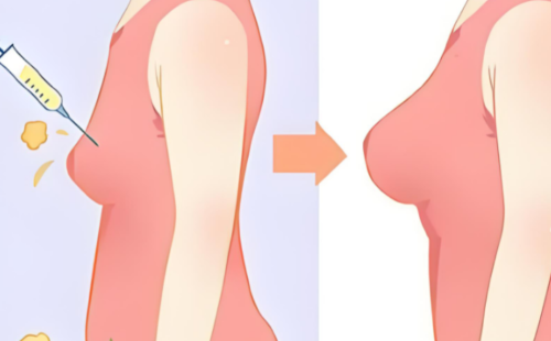 栾杰医生做的自体脂肪隆胸怎么样？技术特点、术后风格和关注点解析