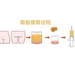 成都面部脂肪填充宋华敬和李烈哪个好？医生信息公布，在线pk！