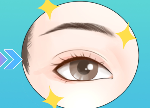 宋建星双眼皮案例分享，不同眼型对比照，看看你适合哪一种弧度