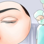 裴旭芳双眼皮案例鉴赏，不同眼型改造前后对比，看看有没有你的同款