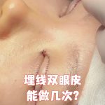 微创双眼皮手术：微创双眼皮手术适合哪些人群？