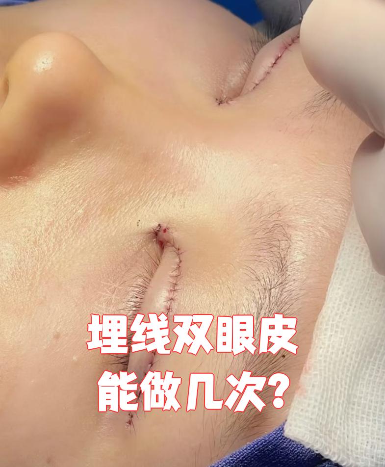 微创双眼皮手术：微创双眼皮手术适合哪些人群？