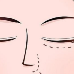 田忠建做双眼皮稳吗？从对称度、持久性到修复率来判断