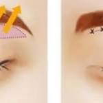 福州做提眉比较好的医生有那些？ 朱刚强、薛克墘、吴诗权等本地整友力推