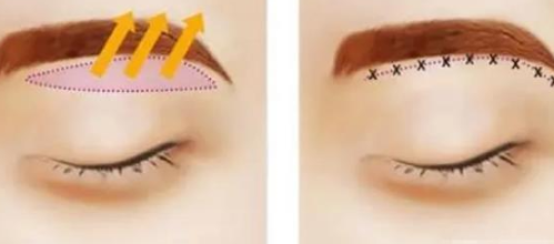 福州做提眉比较好的医生有那些？ 朱刚强、薛克墘、吴诗权等本地整友力推