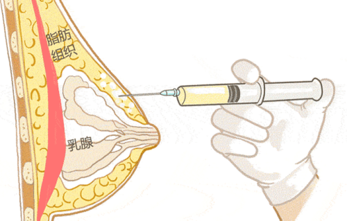 王志国隆胸是做的脂肪胶吗？常用方式、材料选择和适应人群一次说明白