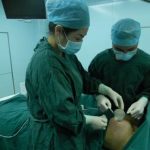 无痕假体丰胸 自然真实不留疤