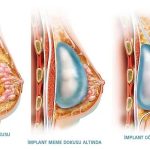 假体隆胸后还能喂奶吗？专家说实话