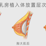 假体隆胸影响哺乳吗？隆胸后哺乳要注意哪些方面