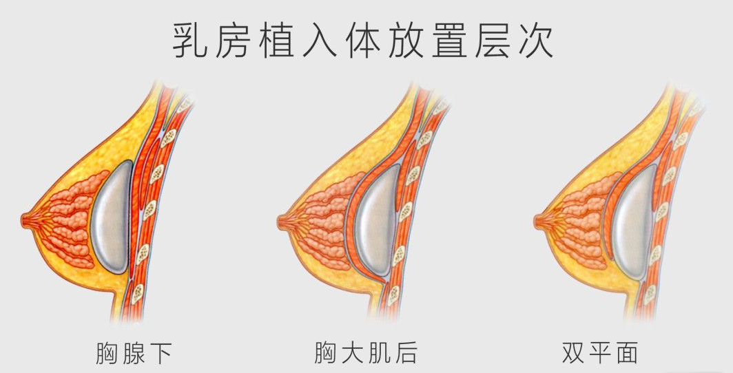 假体隆胸影响哺乳吗？隆胸后哺乳要注意哪些方面