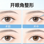 做开眼角哪家医院好？专业推荐与选择指南|如何选择正规医院