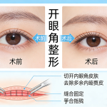 开眼角整形手术注意事项和效果分析|打造明亮双眼的秘诀