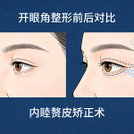 怎样开眼角？详细步骤与注意事项||怎样开眼角手术适合哪些人群