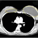 注射隆胸需要多少钱？注射隆胸一次可以保持多久？