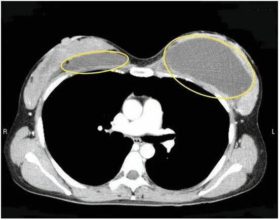 注射隆胸需要多少钱？注射隆胸一次可以保持多久？