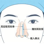 北京耳软骨隆鼻尖需要多少钱？耳软骨隆鼻尖整形介绍