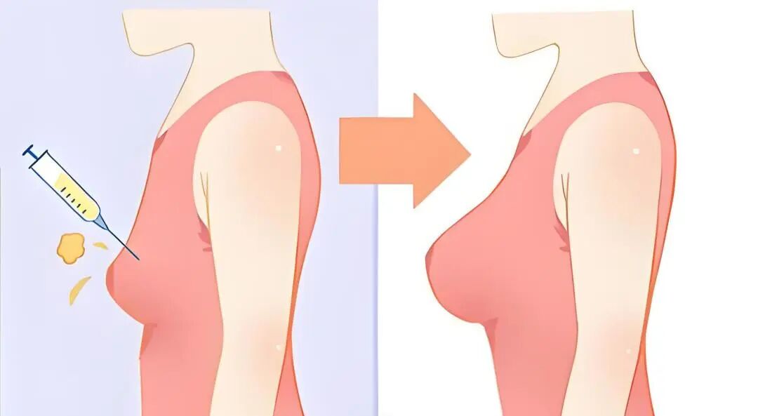 自体脂肪移植隆胸(自体脂肪移植隆胸有后遗症吗)