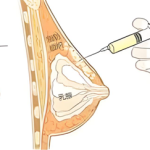 自体脂隆胸手术操作过程|自体脂肪隆胸手术需要多长时间？