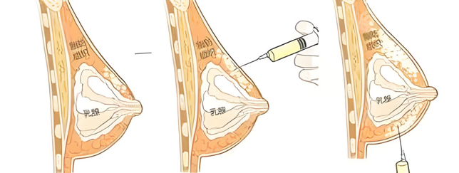自体脂隆胸手术操作过程|自体脂肪隆胸手术需要多长时间？