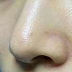 耳软骨、鼻中隔软骨、肋软骨，隆鼻到底该怎么选？