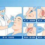 隆鼻手术安全么？怎样选择隆鼻材料与隆鼻方式
