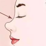 从“鞍”到“峰”：你的鼻子也可以拥有挺拔线条！