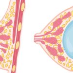 韩式假体隆胸痛吗？介绍手术全过程及术后恢复