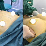 韩式自体脂肪隆胸手术介绍|适合什么样的人？