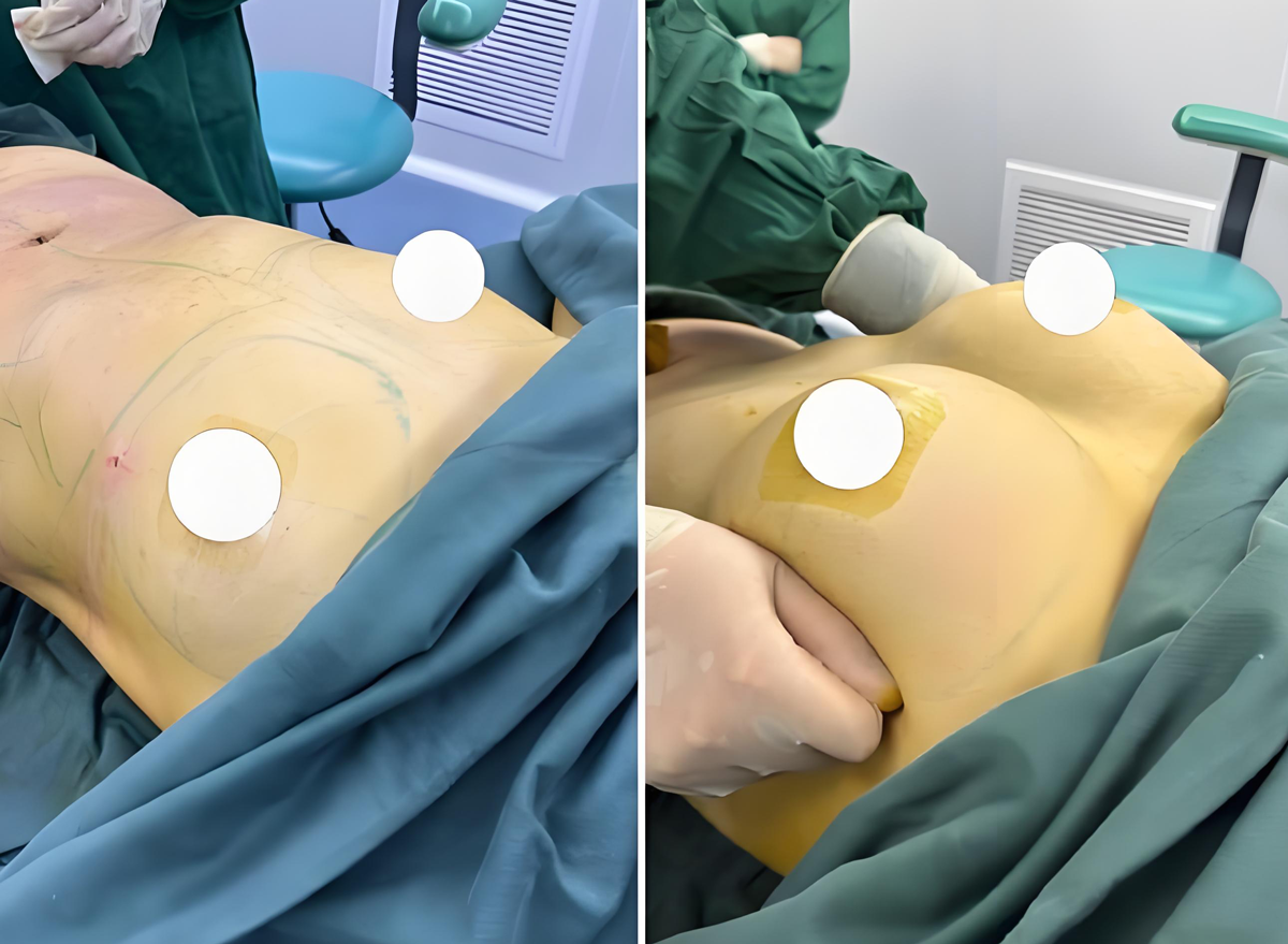 韩式自体脂肪隆胸手术介绍|适合什么样的人？