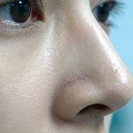 鼻中隔软骨隆鼻医院怎么选？看透这三点不踩坑