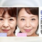 去皱纹的针有副作用吗？打完针后需要注意什么？