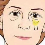 卢尚兵做眼袋手术怎么样？内附医生信息与技术详情！