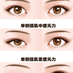 做双眼皮手术一定要提肌吗？