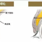 双眼皮手术损伤越小越好吗？