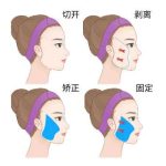 西安伍航利大拉皮手术怎么样？深度解析其专长与坐诊医院详情，附价格表