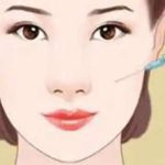 上海长征医院袁湘斌下巴填充90天案例分析
