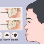 朱石江颌面手术怎么样？沈阳杏林磨骨专家，价格38000元起！