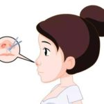 西安刘翔宇医生做鼻子怎么样？技术多样化+真实案例分享，口碑超稳