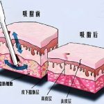 嘉兴吸脂做得比较好的医生哪个比较好？五位 “脂肪塑形大师” 的瘦身技巧分享