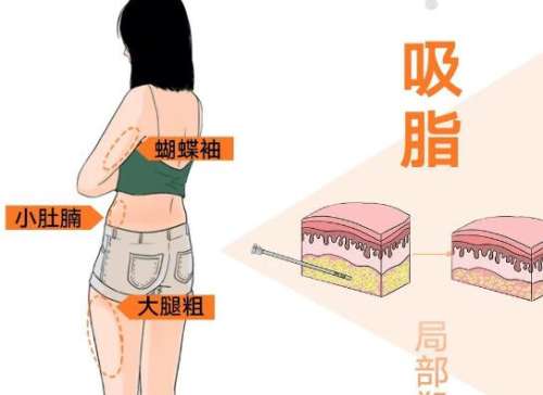 昆明吸脂做得比较好的医生有哪些？5位实力派医生名单在这看