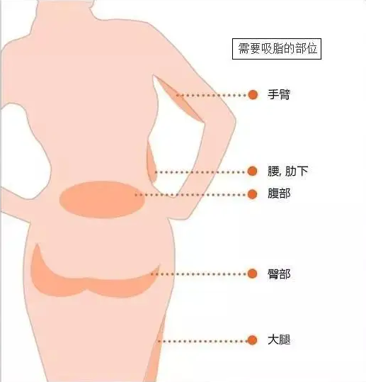 双下巴吸脂的操作方式及护理