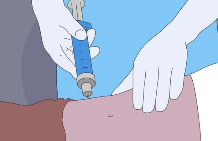 谁可以做流体动力吸脂呢？安徽省立医院整形告诉你