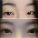 全切双眼皮和埋线双眼皮那个好？看完您就明白了！