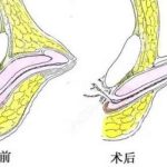 重庆李世荣医生咋样？阴茎延长增粗专家，技术和价格曝光